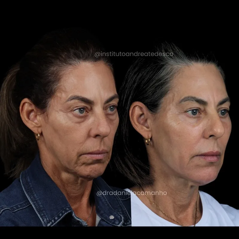 Antes e depois: Rejuvenescimento e sustentação — vista lateral