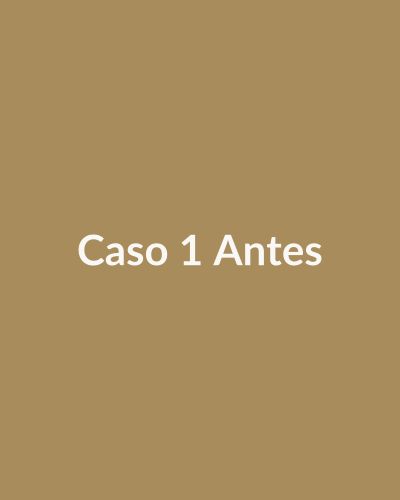 Antes: Preenchimento de olheiras + contorno mandibular